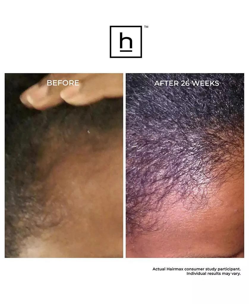 HairMax Laserband 41 Comfortflex 5