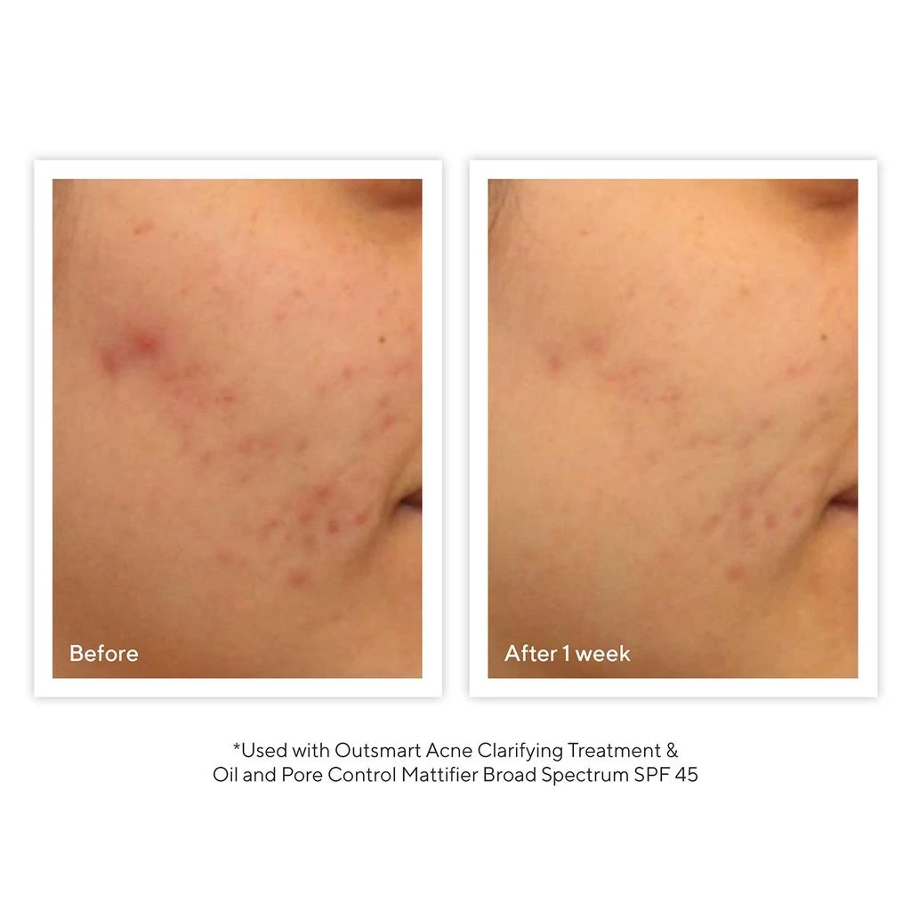 Murad Murad Outsmart Acne Clarifying Treatment 1.7 oz 3