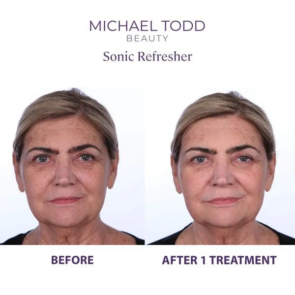 Michael Todd Beauty Michael Todd Beauty Sonic Refresher Wet/Dry Sonic Microdermabrasion and Pore Extraction System (Various Shades) 7