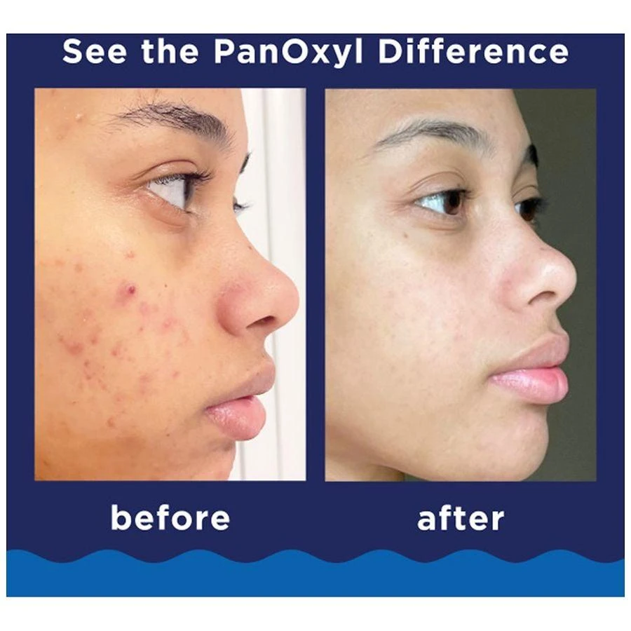 PanOxyl Foaming Acne Wash Maximum Strength 10% Benzoyl Peroxide 5