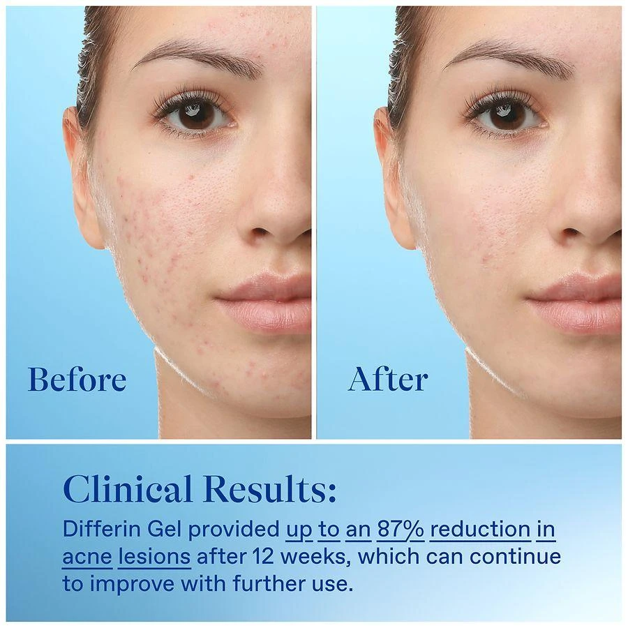 Differin 0.1% Adapalene Acne Treatment Gel 2